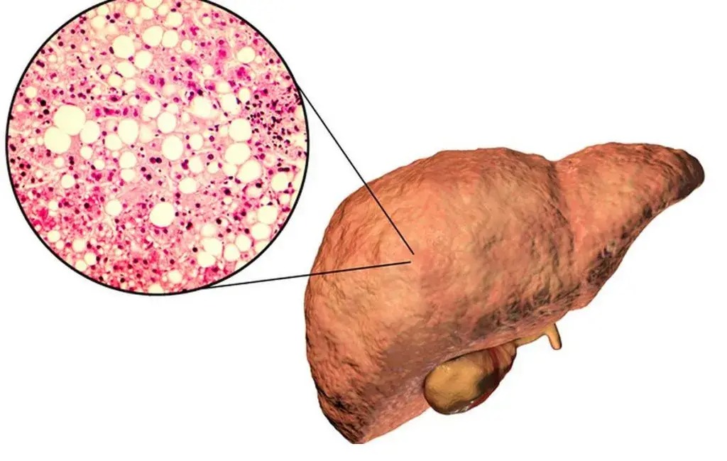 هپاتیت به کدام قسمت بدن آسیب می زند؟ ایا خطرناک است؟